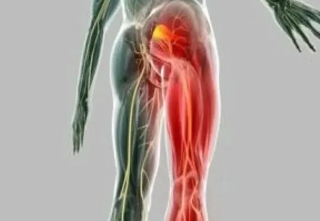 Tratamiento para ciática y dolor irradiado